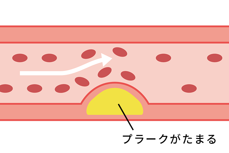 狭心症イメージ画像