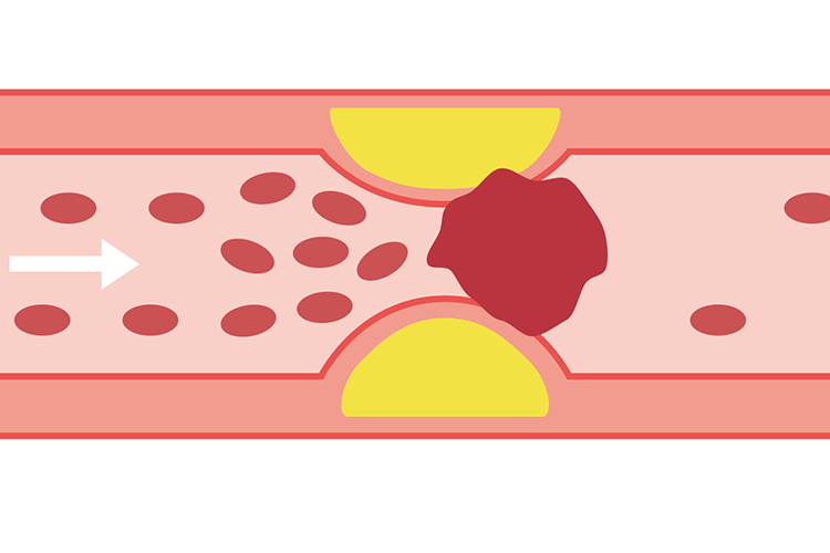 心筋梗塞イメージ画像