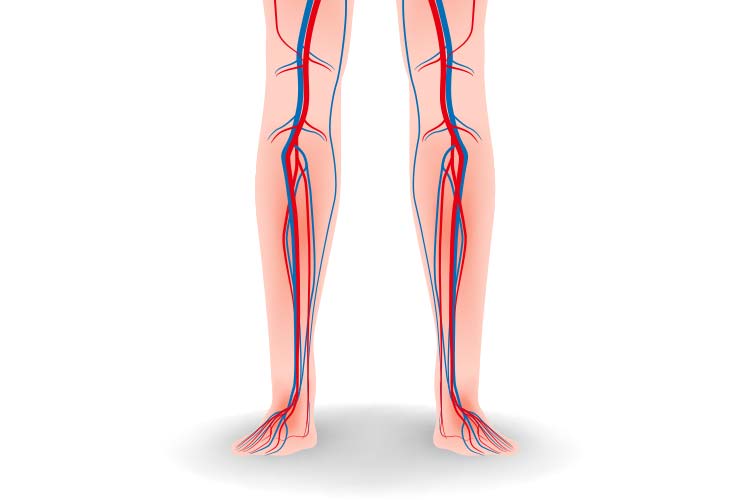 下肢閉塞性動脈硬化症イメージ画像